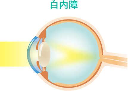 白内障の目のイラスト